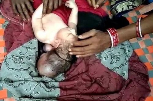 3 headed chilld born in uttar pradesh