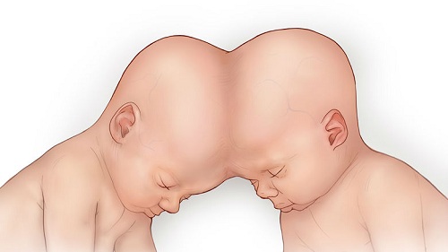 conjoined twins illustration 16x9 1